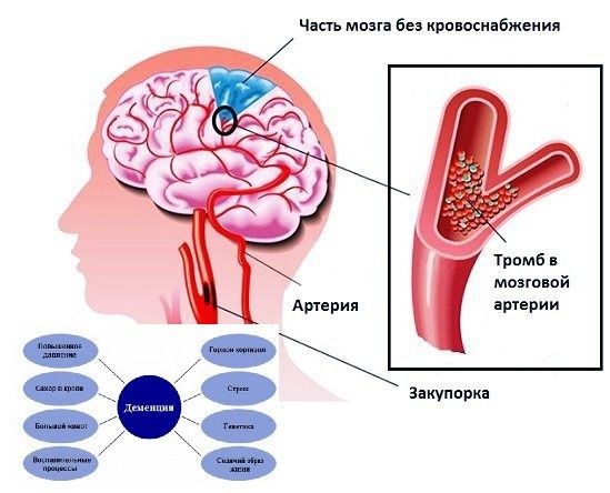 Деменция у взрослых