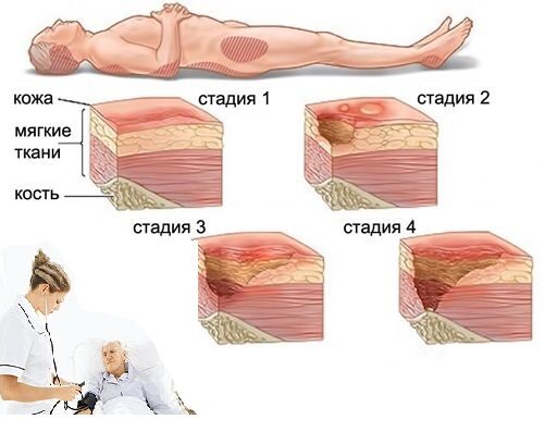 стадии пролежней и их лечение